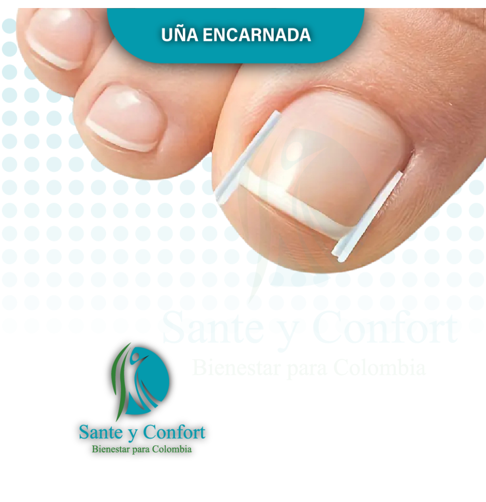 uña encarnada